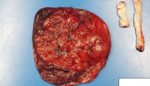 The maternal side of a placenta from a patient with coronavirus, connected to the umbilical cord. Evidence of the disease process in the placenta is not visible in this photo.  (Northwestern University)