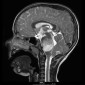 MRI Image of a pediatric brain tumor