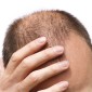 A balding man puts his right hand in his receding hair.