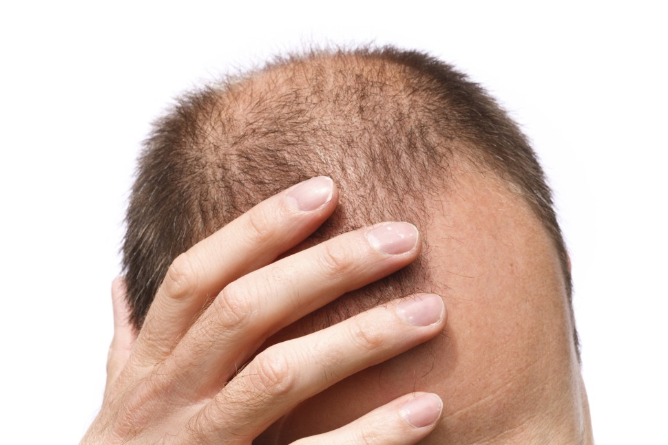 A balding man puts his right hand in his receding hair.