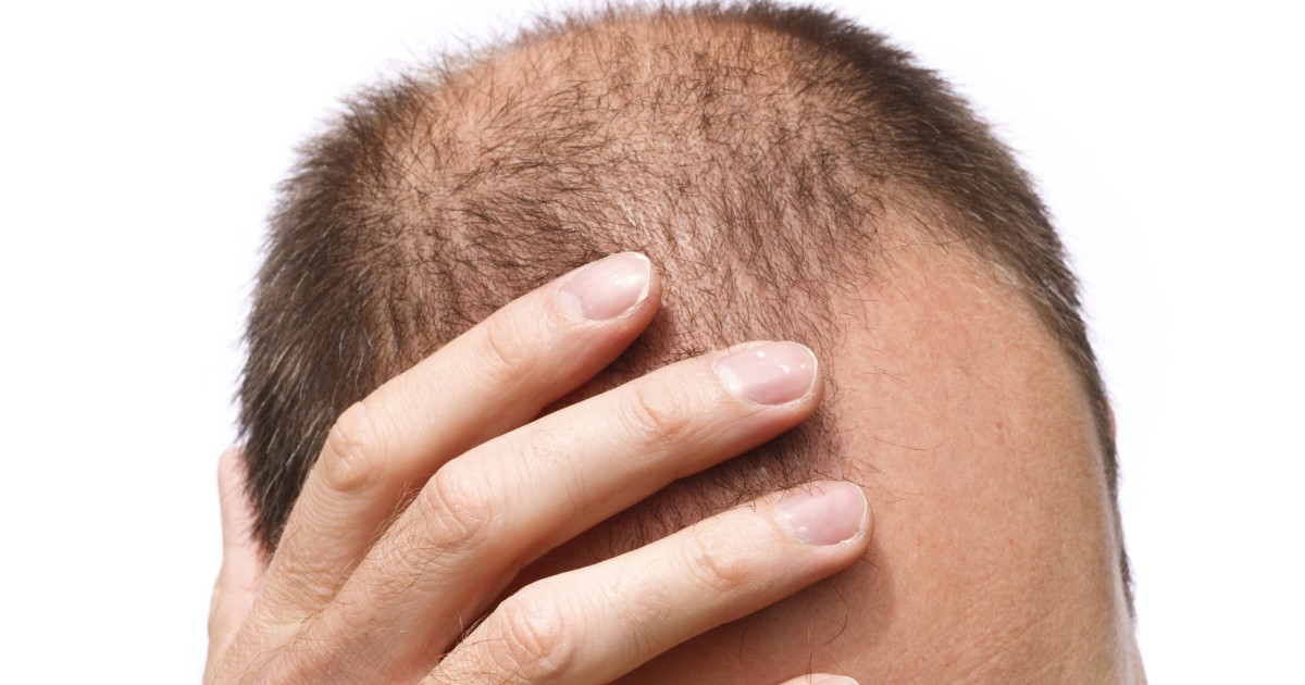 Hair loss Who gets and causes