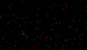 Micrograph of human neurons that were exposed to amyloid-beta proteins and not treated with the new therapy. Neurons in red are dead; living neurons are in green.