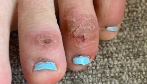 A teenage patient's foot as pictured on April 21, 2020, four weeks after the onset of the skin condition being informally called "COVID toes." (Photo courtesy of Dr. Amy Paller, Northwestern University)