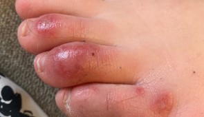A teenage patient's foot as pictured on April 6, 2020, three days after the onset of the skin condition being informally called "COVID toes." Notice the dusky hue to the discoloration. (Photo courtesy of Dr. Amy Paller, Northwestern University) 