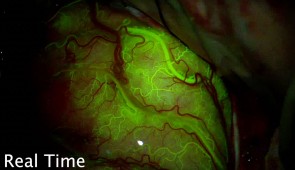 This video demonstrates the dynamic opening of the BBB opening intra-operatively. Following brain sonication and administration of intravenous microbubbles, scientists injected fluorescein intravenously, as this dye does not normally penetrate into the brain. They first observed fluorescein in the arteries, then the whole brain was fluorescent, as this dye was in the capillaries, followed by the brain veins. Eventually, after a few minutes, they observed accumulation of this dye in the brain regions that were sonicated where the blood-brain barrier was opened. (Credit: The Lancet Oncology)