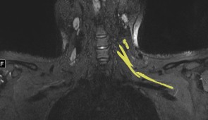 An MR image of a patient in their early 20s shows nerve injury (highlighted in yellow) of the left brachial plexus in the neck. The patient experienced left arm weakness and pain after recovering from COVID-19 respiratory illness, which prompted them to see their primary care physician. As a result of the MRI findings, the patient was referred to the COVID-19 neurology clinic for treatment.