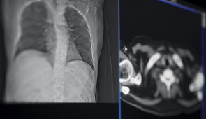 Chest CT scan images.