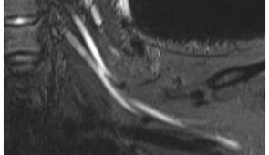 Close-up MR image of nerve damage in the left brachial plexus in the neck of a patient in their early 20s. The patient experienced left arm weakness and pain after recovering from COVID-19 respiratory illness, which prompted them to see their primary care physician. As a result of the MRI findings, the patient was referred to the COVID-19 neurology clinic for treatment.