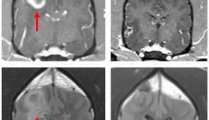 MRI scans of a dog's brain with glioblastoma. The image in the top left panel shows a large, bulky tumor before being injected with the STING agonist. The bottom left image shows the diffuse infiltration of the tumor before treatment with the STING agonists. The top right image shows the brain 12 weeks later in which the bulky tumor has disappeared after treatment. The bottom right image shows the associated infiltration has resolved after treatment with the STING agonist. (Source: Texas A&M)