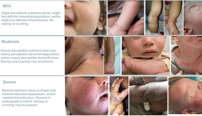Scorecard used in the study to help pediatricians identify severe eczema