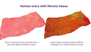 A side-by-side comparison of the same human ovary. The left was stained with a dye that detects fibrotic tissue. The right analyzed the sample with artificial intelligence. (Credit: Northwestern University)