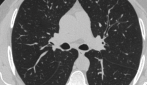 A de-identified CT scan of a study participant with healthy lungs. 