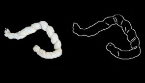 A photo of a hypercoiled umbilical cord (left) next to an artificial intelligence image of the same umbilical cord (right).