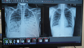 Lung cancer patient scans before and after transplant.