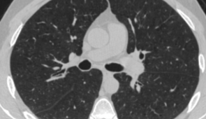 A de-identified CT scan of a study participant with mild emphysema. 
