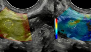 An ultrasound image of a human ovary that used shear wave elastography to assess ovarian stiffness by detecting and measuring fibrotic tissue. (Credit: Northwestern University)