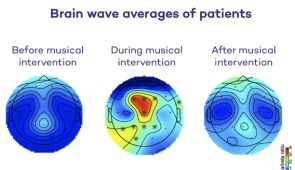 Brain wave averages of all five participants in the study before, during and after the 40-minute musical intervention. The dark blue represents predominantly fast-moving beta waves while patients were fidgety, and feeling stressed. During clinically designed improvisatory music (CDIM), the brainwaves transitioned to predominantly calmer, slower-moving alpha waves (red, orange, yellow) that were concentrated in the middle and front of the brain, which is where meditation occurs. After the musical intervention, the brain waves continued to remain calm for 20 minutes, illustrating how music’s effects can linger.
