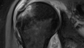 MRI image of a patient's shoulder. The red arrow points to inflammation in the joint. The COVID virus triggered rheumatoid arthritis in this patient with prolonged shoulder pain after other covid symptoms resolved.