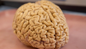 SuperAger brain in the lab. (Credit: Shane Collins, Northwestern University)