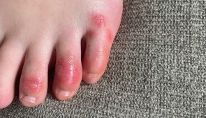 A teenage patient's foot as pictured on April 3, 2020, at the onset of the skin condition being informally called "COVID toes." (Photo courtesy of Dr. Amy Paller, Northwestern University)