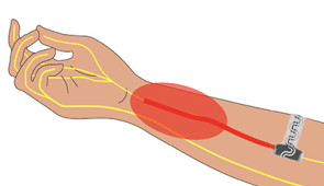 Ilustration of the implantable device inside an arm. The red oval indicates pain. The device softly wraps around the peripheral nerve to silence signals to the brain.