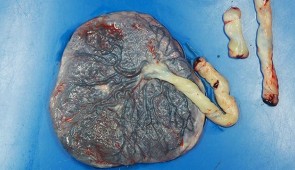 The fetal side of a placenta from a patient with coronavirus, connected to the umbilical cord. Evidence of the disease process in the placenta is not visible in this photo. (Northwestern University)