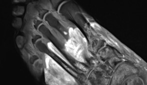 MRI of the foot in a patient with severe COVID-19.  The grey part of the foot is devitalized tissue (gangrene).