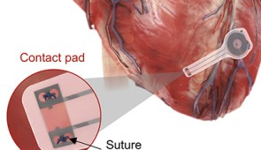 Illustration of the device mounted on a heart, with annotation