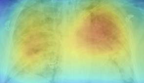 Generated heat maps appropriately highlighted abnormalities in the lung fields in those images accurately labeled as COVID-19 positive.