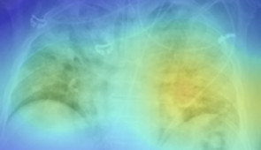 Generated heatmaps appropriately highlighted abnormalities in the lung fields in those images accurately labeled as COVID-19 positive