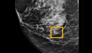 A yellow box indicates where an AI system found cancer hiding inside breast tissue. Six previous radiologists failed to find the cancer in routine mammograms.