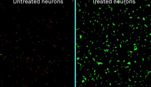Labeled micrographs of human neurons exposed to amyloid-beta proteins and either left untreated (left) or treated with the new nanotherapy developed at Northwestern (right). Dead neurons are stained in red; live neurons are green.