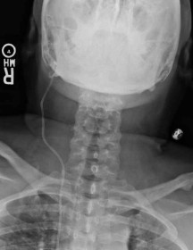 X-ray of chest showing shunt