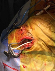Functional shunt protruding from the brain during surgery