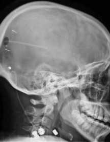 X-ray of skull with shunt
