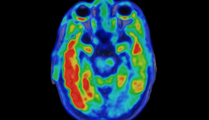 A top-down view of a tau PET and MRI from a participant in the Northwestern study. Warmer colors (red) indicate high Alzheimer's disease tau pathology. (Image orientation: left is left, right is right).