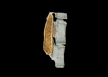 The colored region in a micro-CT image shows regenerated high-quality bone in the spine with minimal use of growth factor.