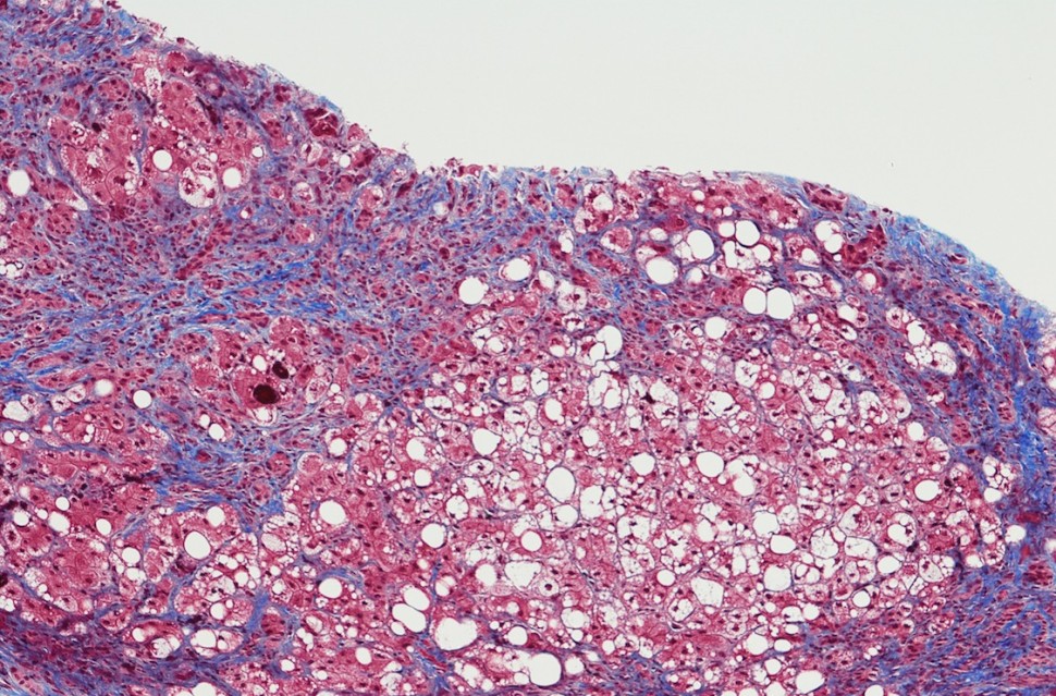 Cirrhosis of the liver with hepatic steatosis and chronic hepatitis