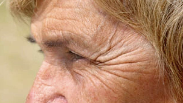 Facial wrinkles