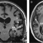 brain