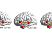 brain networks speech impairment dementia