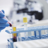 Hematopoietic stem cells are taken from the patient’s bone marrow or blood, then their immune stem is wiped out with chemotherapy. 