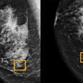 ai breast cancer detection