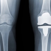 Knee replacement