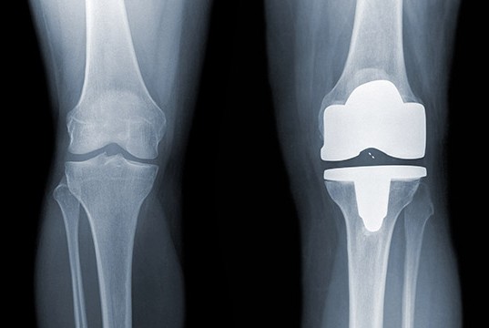 Knee replacement timing is all wrong for most - Northwestern Now