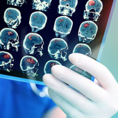 COVID-19 neurological symptoms