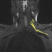 covid pain nerve damage