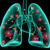 COVID-19 pneumonia