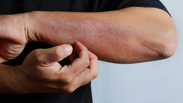 eczema eczema