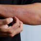 eczema